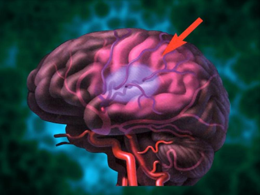 Ишемическая головного мозга новорожденного. Ишемия мозгового инсульта. Ишемия коры головного мозга. Ишемия сосудов головного мозга. Гипоксия сосудов головного мозга.